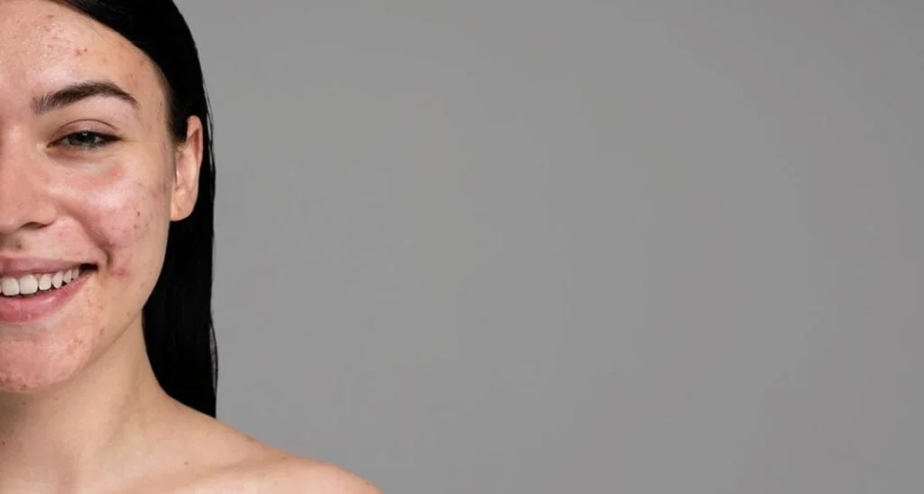 Melasma